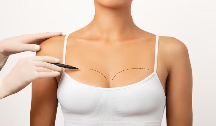 Breast rejuvenation procedure