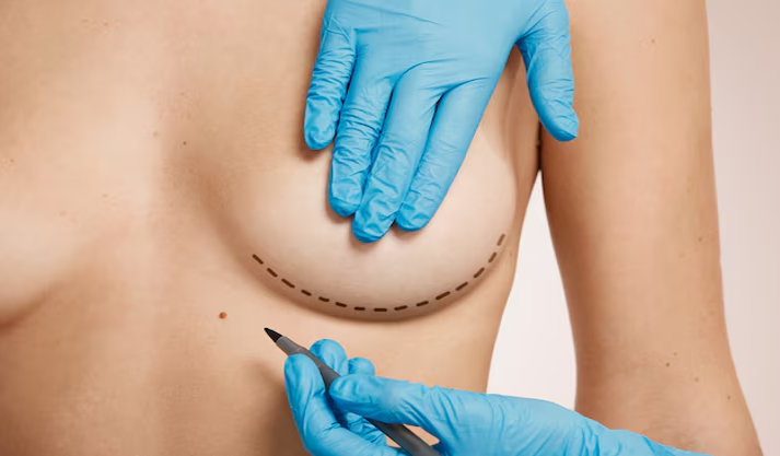 PRP breast treatment
